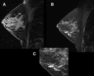 Multimodality breast cancer screening shows possible boon for high-risk women