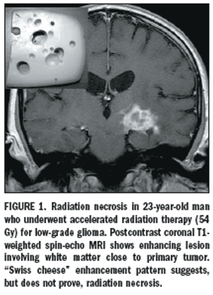 MRS, perfusion MRI separate radiation necrosis from tumor