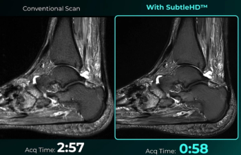Newly FDA-Cleared AI Software Facilitates Advanced Denoising and Accelerated Scan Times for MRI