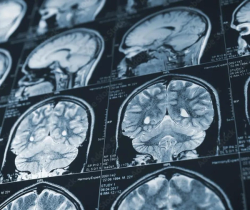 Study Assesses Contributing Factors to Diagnostic Errors in Neuroradiology