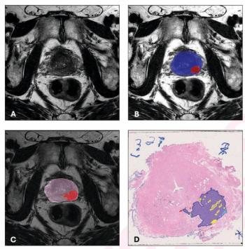 Adjunctive AI Bolsters Lesion-Level PPVs for csPCa in International bpMRI Study
