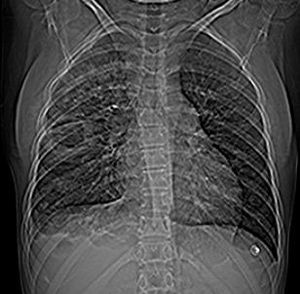 Septic Pulmonary Emboli