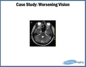 Worsening Vision