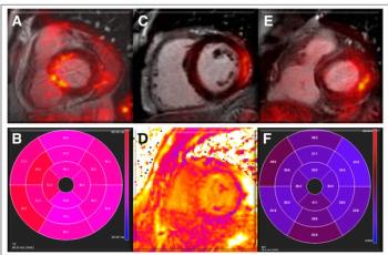 Study Reveals Significant Prevalence of Abnormal PET/MRI and Dual-Energy CT Findings with Long Covid