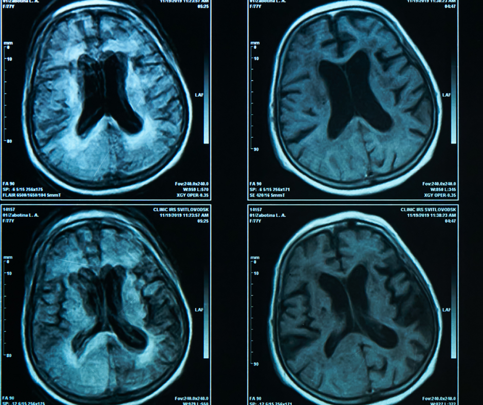 Meta-Analysis Finds High Risk of Bias in 83 Percent of AI Neuroimaging ...