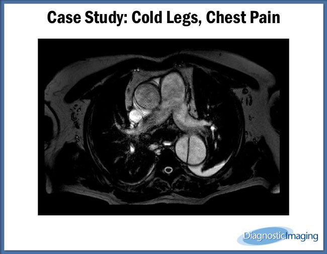 Cold Legs, Chest Pain