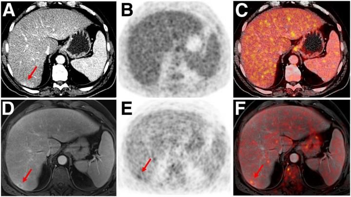 domæne jord dommer PET/MRI Outperforms PET/CT in Cancer Imaging