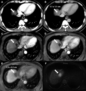 New CT and MRI Research Shows Link Between LR-M Lesions and Rapid Progression of Early-Stage HCC