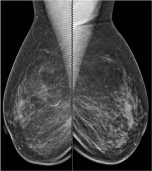 Ductal Carcinoma in Situ