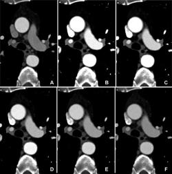 Could Photon-Counting Reduce Iodinated Contrast Media for CT Angiography?