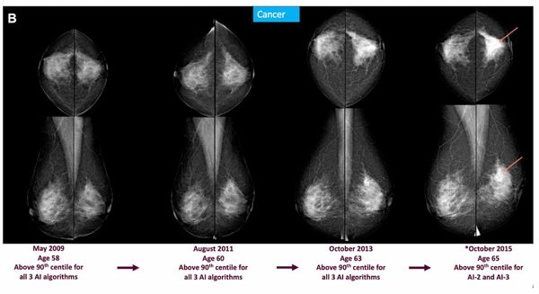 Mammography Study: Can AI Detect Potential Breast Cancer Up to a Decade Prior to Diagnosis?