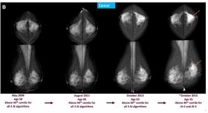 Mammography Study: Can AI Detect Potential Breast Cancer Up to a Decade Prior to Diagnosis?