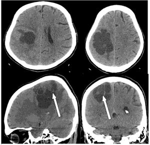 Cystic Meningioma