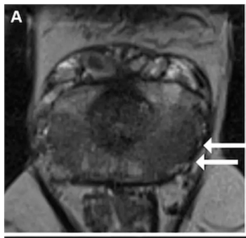 Emerging AI Software for Prostate MRI Offers 95 Percent Sensitivity for csPCa