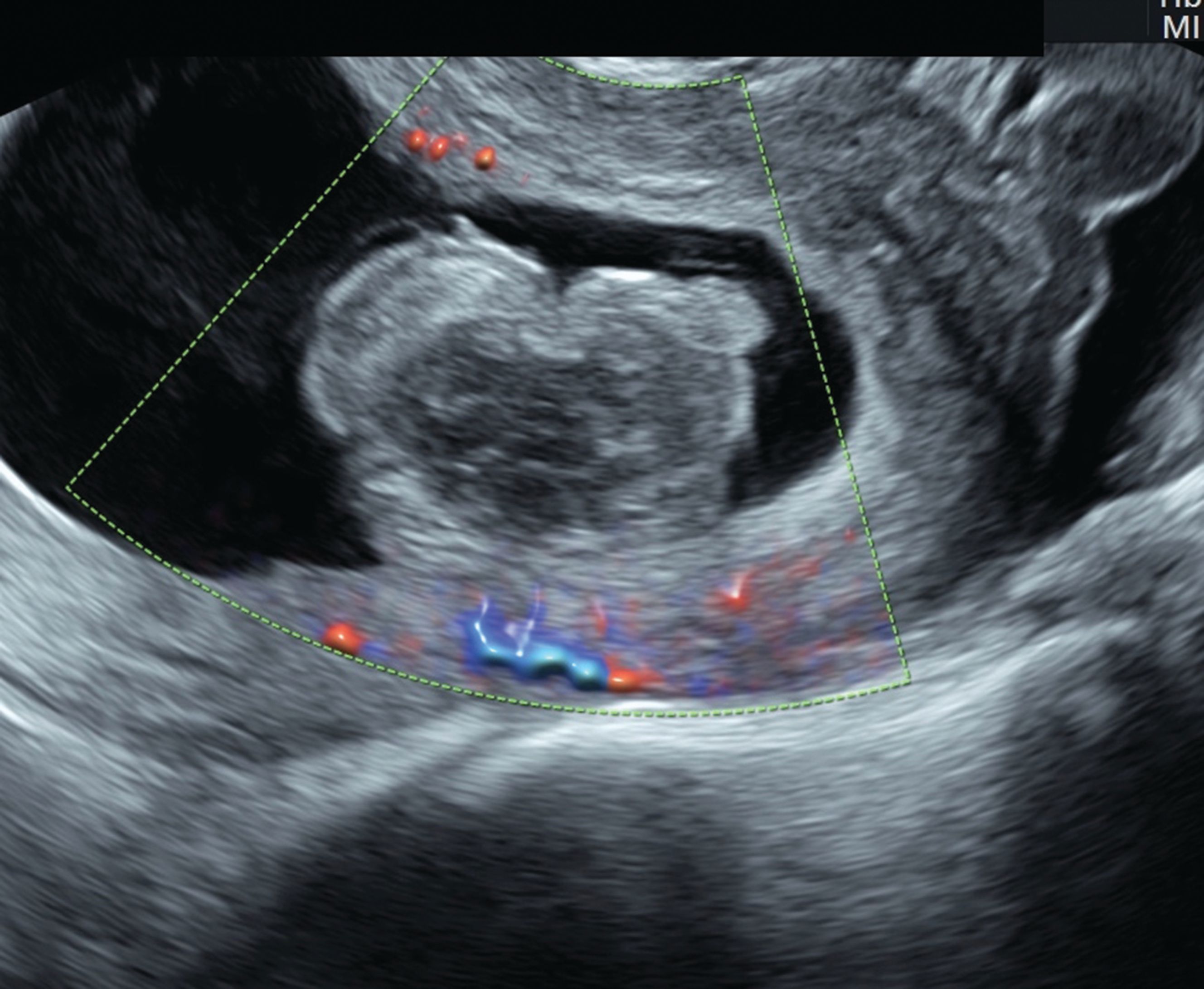 Ultrasound is a Critical Tool of Managing Miscarriage Ultrasound is a Critical Tool of Managing Miscarriage