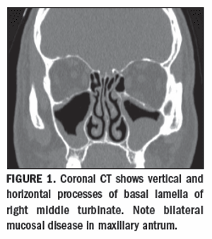 CT and MRI show complexparanasal sinus anatomy