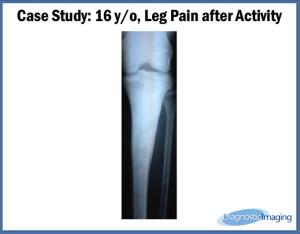 16 y/o, Leg Pain after Activity