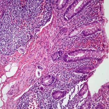 APSI is accurate and simple prediction for complicated appendicitis