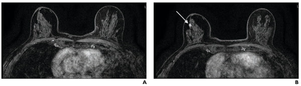 Abbreviated Breast MRI and Dense Breasts: What Emerging Research