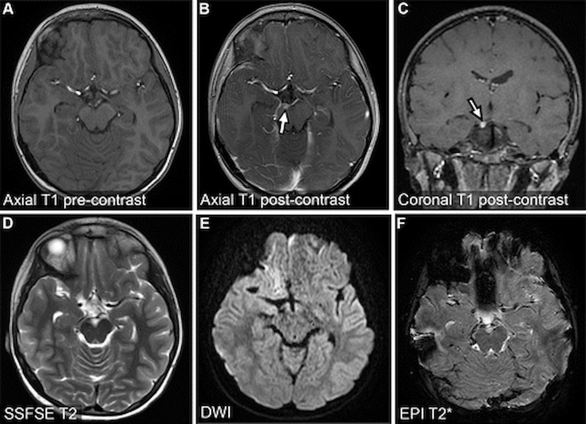 Can Abbreviated MRI Have an Impact in Neuroimaging? | Diagnostic