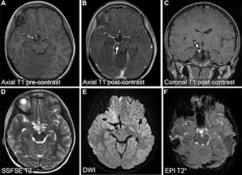 Can Abbreviated MRI Have an Impact in Neuroimaging?