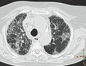 Usual Interstitial Pneumonia