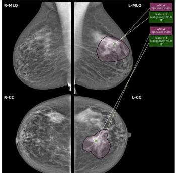 Considering Breast- and Lesion-Level Assessments with Mammography AI: What New Research Reveals