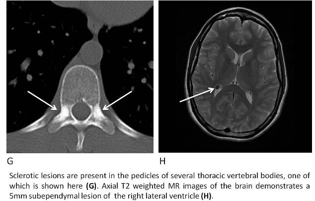 Tuberous Sclerosis Complex