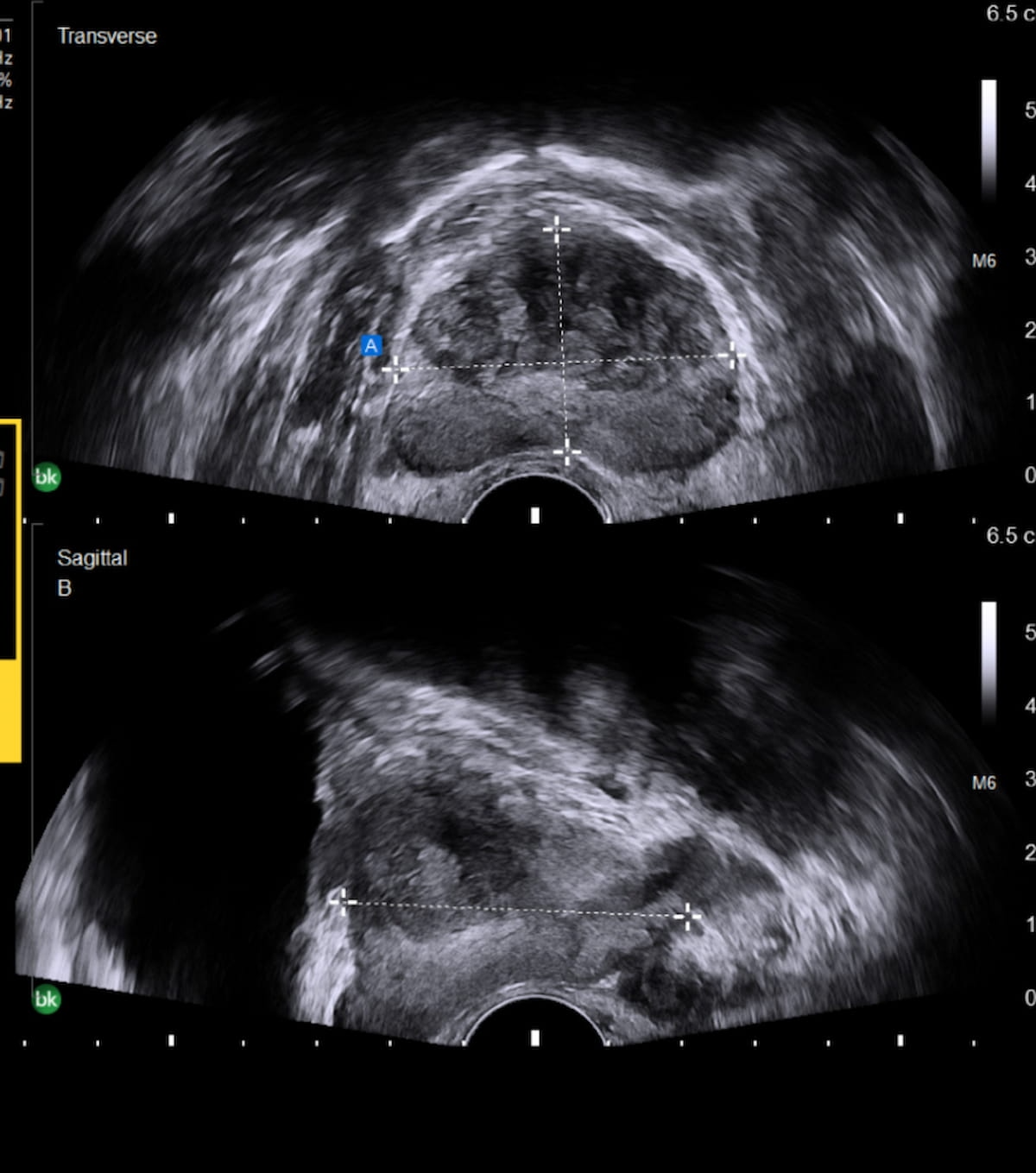 Measuring Shape Prostate GE HealthCare Launches AI-Powered Prostate Volume Assist for Ultrasound