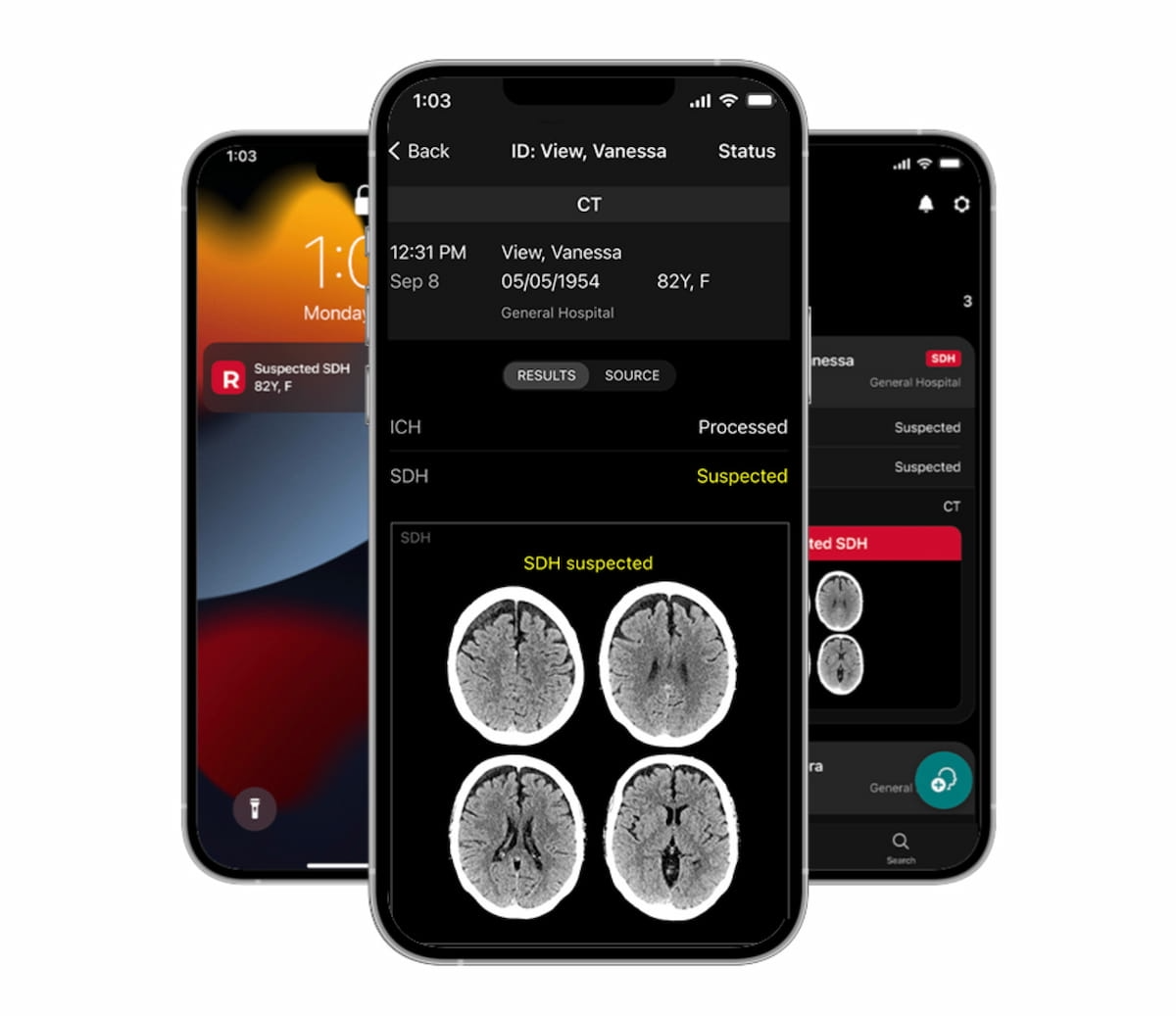 FDA Clears AI-Powered Module for Detecting Hemispheric Subdural Hematomas on CT