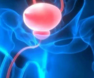 New Study Shows Benefits of Prostate Artery Embolization for Men with an Enlarged Prostate