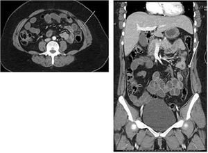 Epiploic Appendagitis
