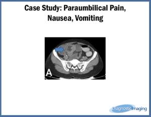 Paraumbilical Pain,  Nausea, Vomiting