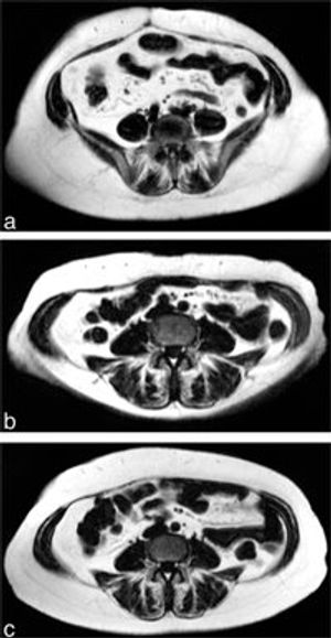MRI Shows Improved Heart Function after Low-Calorie Diet