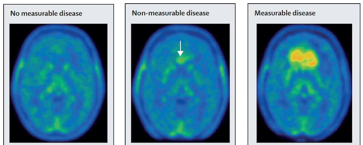 Emerging PET Agent Gets FDA Fast Track Designation for Glioma Imaging