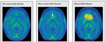 Emerging PET Agent Gets FDA Fast Track Designation for Glioma Imaging