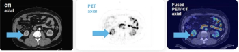 Emerging PET/CT Agent May Enhance Diagnosis for Smaller Lesions of Clear Cell Renal Cell Carcinoma