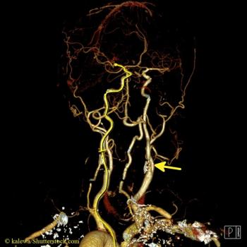 Phase-contrast flow MRI helps diagnose carotid stenosis