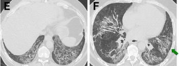 Study Examines Key CT Features for Differentiating Fibrotic Interstitial Lung Disease