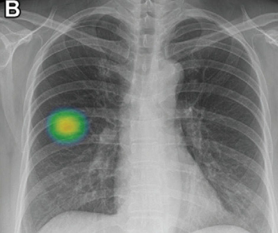 Study: AI More Than Doubles the Sensitivity Rate for Lung-RADS Category 4 Nodules on Chest X-Rays