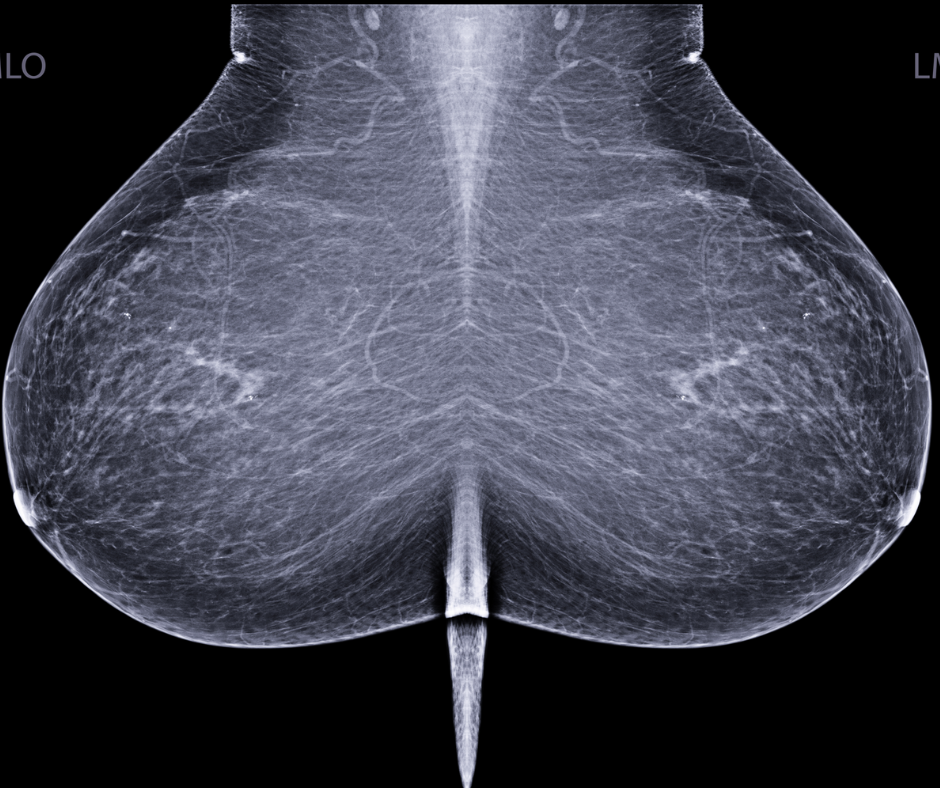What a New Review Reveals About Mammography-Based AI and Breast Cancer Risk Assessment