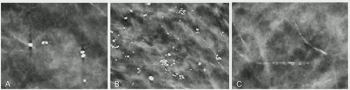 Mammography Study Compares False Positives Between AI and Radiologists in DBT Screening