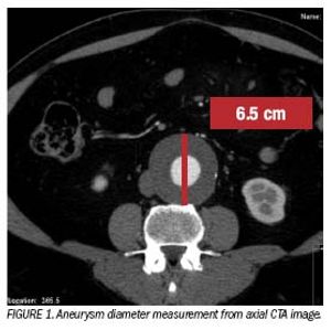 CT angiography helps planendovascular aneurysm repair