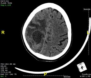 Image IQ: 75 y/o Male, Left-sided Weakness, Headache