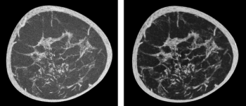 Koning Corporation Launches AI Software for 3D Breast CT