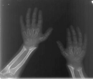 Image IQ: Coarse Facial Features, Short Stature, Spinal Deformity