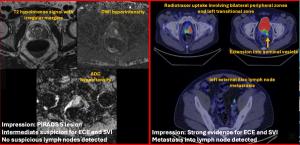 Should PSMA PET/CT Supplant MRI For Staging of Patients with High-Risk PCa?