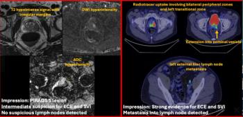 Should PSMA PET/CT Supplant MRI For Staging of Patients with High-Risk PCa?