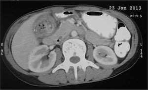 Bouveret’s Syndrome Due to Cholecystoduodenal Fistula
