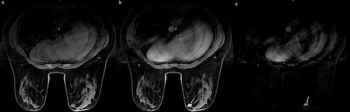 Can Abbreviated MRI Have an Impact in Differentiating Intraductal Papilloma and Ductal Secretion?